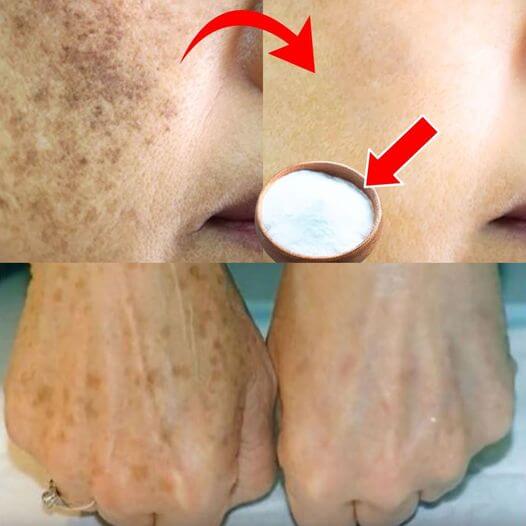 I Erased My Age Spots with a Cheap Kitchen Ingredient Baking Soda 1