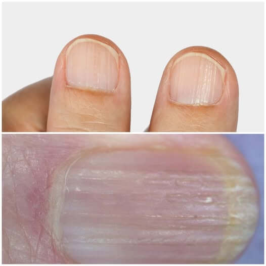 What Causes Vertical Ridges on Nails 1
