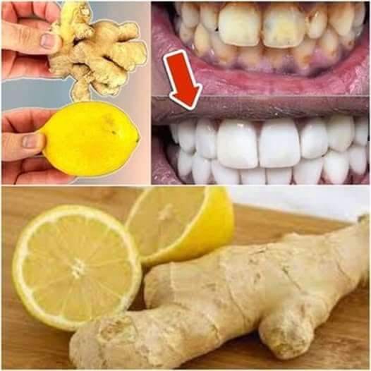 Yellow, Dirty Teeth Become Milky White and Shiny using Lemon and Ginger 1
