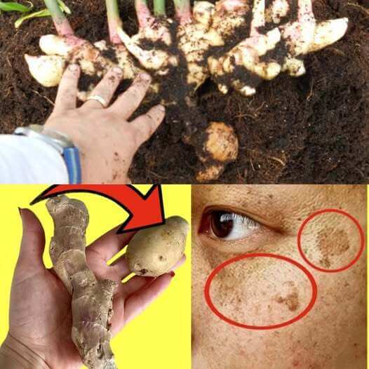 She Wiped the Dark Spots Off Her Face with Potatoes and Ginger in Just 20 Minutes 1