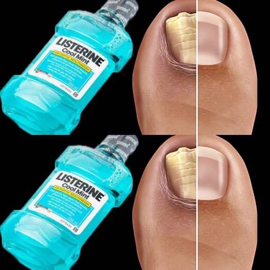 THIS EASY RECIPE Will Get Rid of Nail Fungus 1