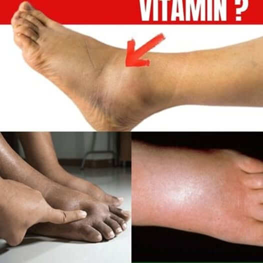 The No.1 Vitamin for Removing Leg and Foot Swelling 1