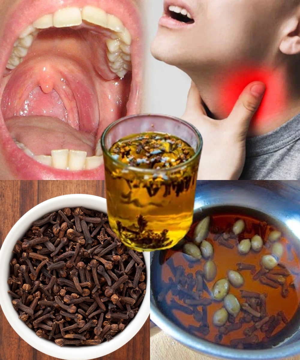 Kills Sore Throat and Inflammation Cloves Nature’s Antibiotic 1