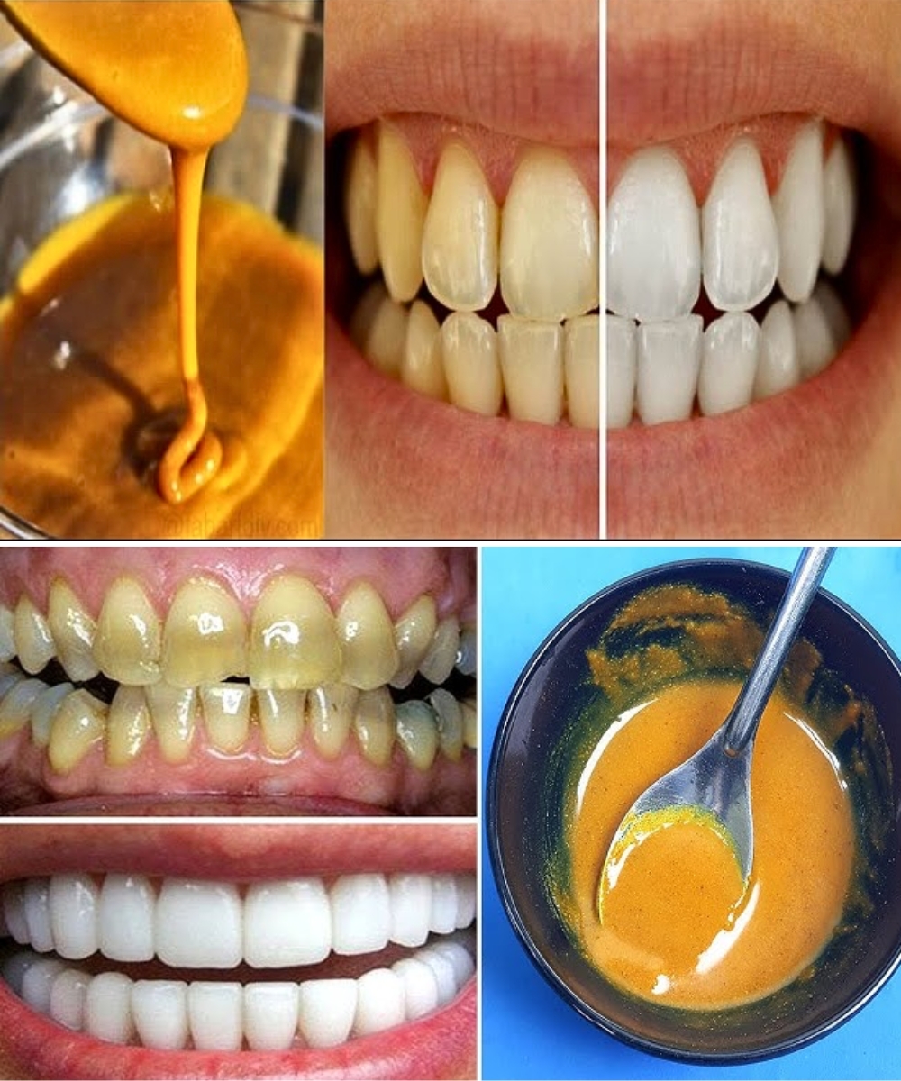 Homemade Toothpaste to Whiten Teeth & Reverse Gum Disease Using Turmeric, Coconut Oil & Peppermint 1