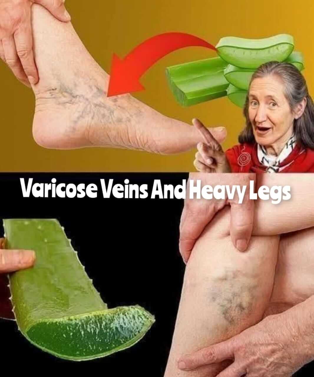 Varicose Veins and Heavy Legs With 100% Effective Aloe Vera Leaf 1