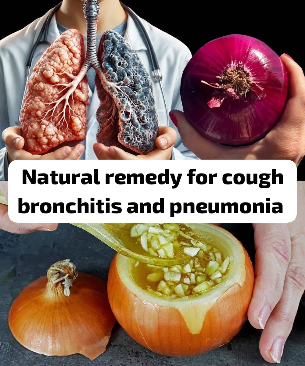 The Antibiotic of Onions for Pneumonia, Bronchitis, and Cough 1