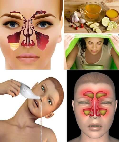 Effective Natural Solutions To Quickly Reduce Sinus Pressure And Congestion 1