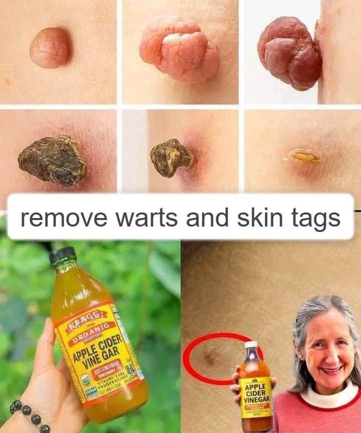 Say Goodbye to Plantar Warts and Skin Tags Naturally 1