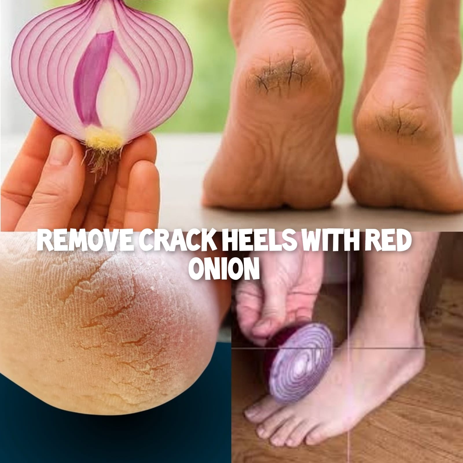 The Red Onion Foot Reset Permanent Relief for Cracked Heels 1