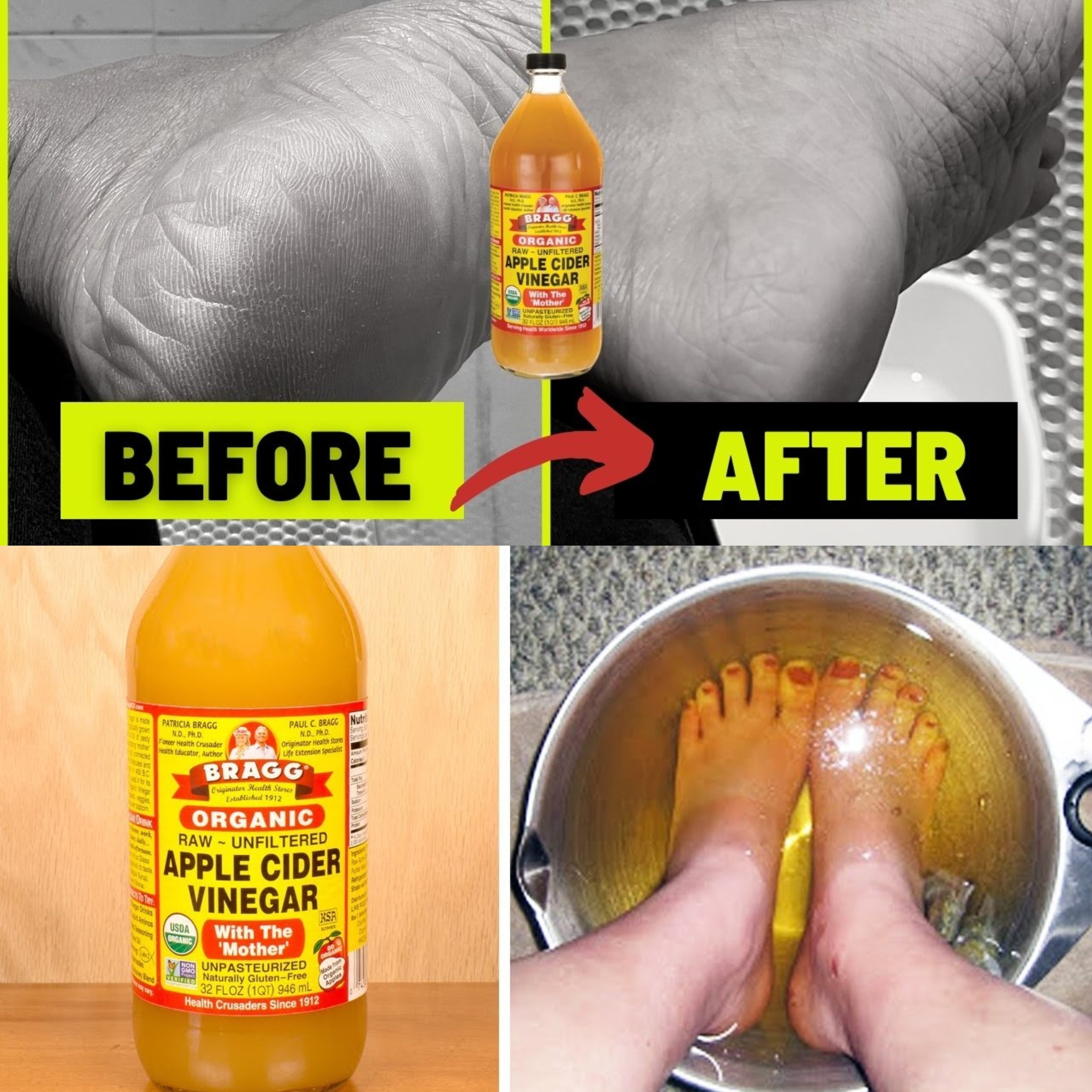 I soaked my feet in APPLE CIDER VINEGAR and 15 minutes later I was shocked at what happened 1