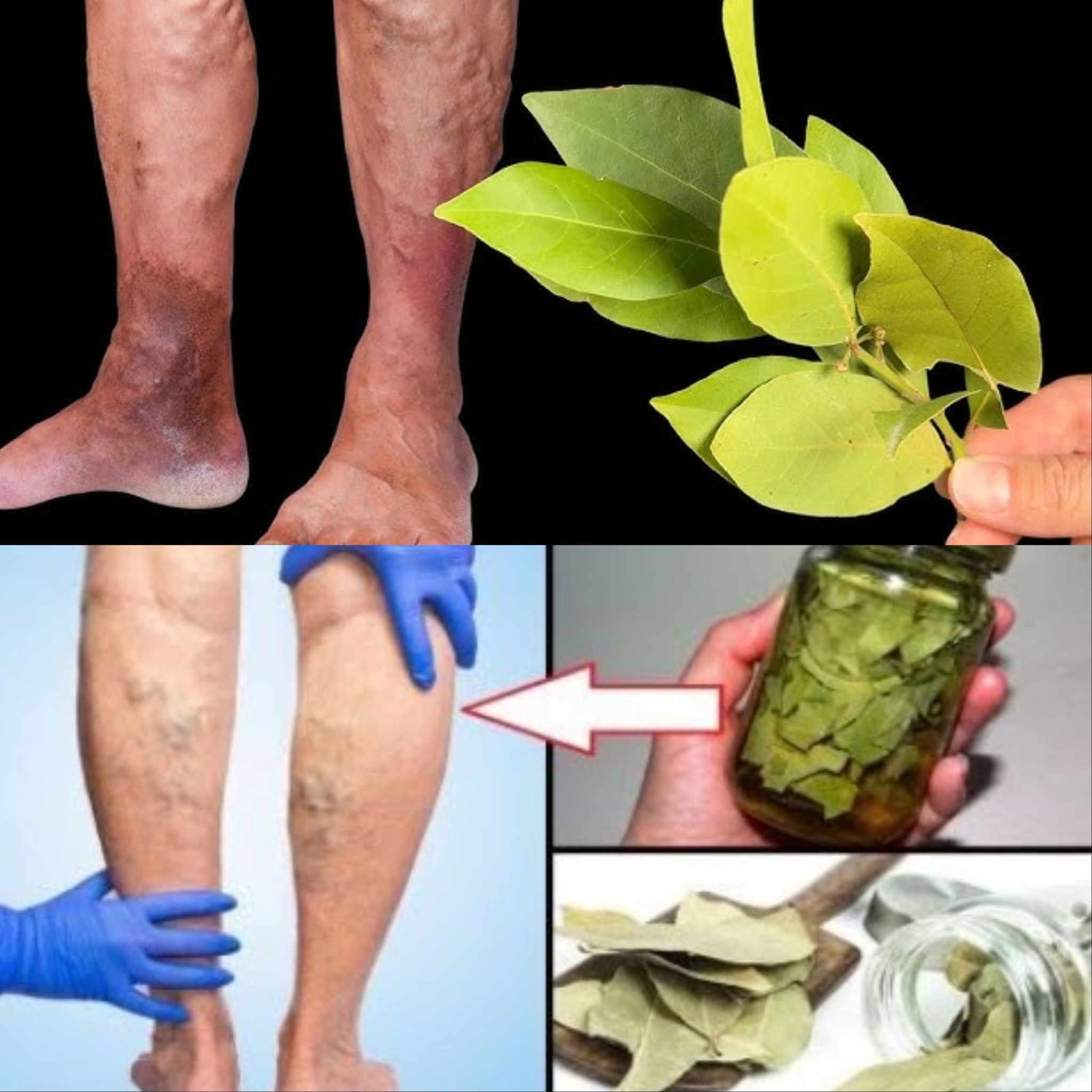 Unbelievable! Get rid of varicose veins with bay leaf 1